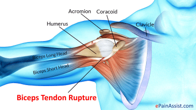 cause-of-ruptured-tendons-of-the-biceps