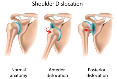 dislocated-shoulder
