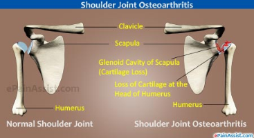 osteoarthritis-shoulder