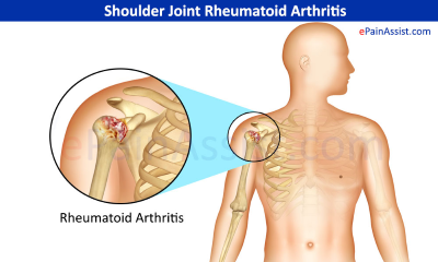 rheumatoid-arthritis-for-shoulder