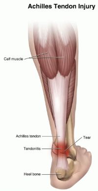 achilles-tendon-injury