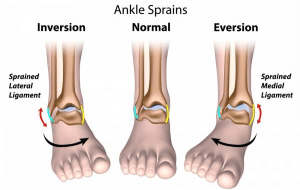 ankle-sprain-pain